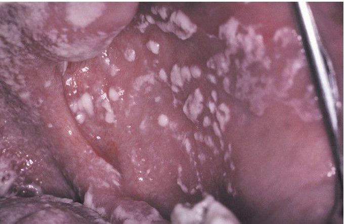 HIV-associated Candidiasis