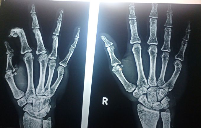 Metacarpal fracture