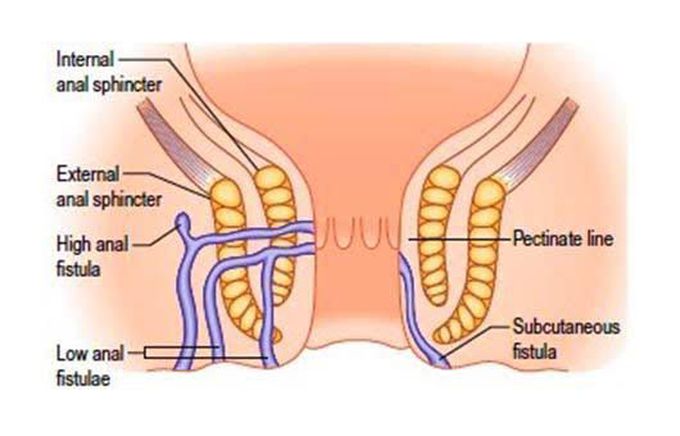 Anal Fistulas