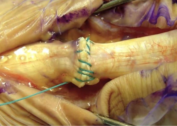 Sutured Achilles