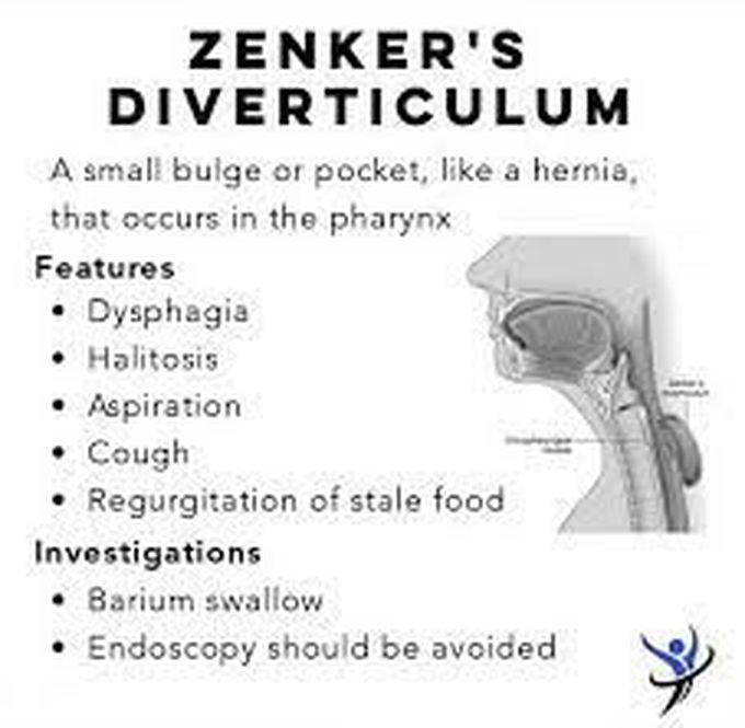 Treatment of zenkers diverticulum