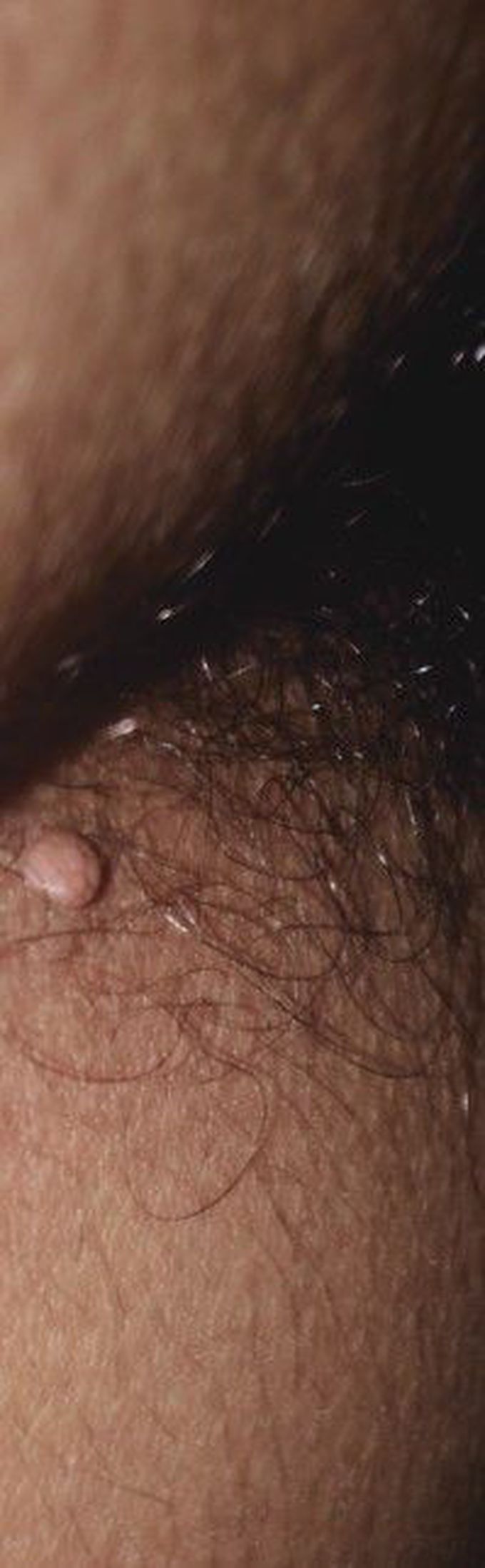 what is this called.? is this normal or not. this suddnly grew up out side anus