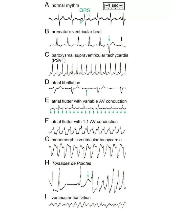 Normal Vs abnormal heart rhythms