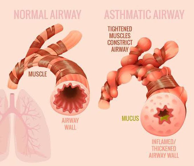 Asthma