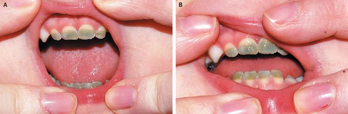 Green Teeth in Neonatal Sepsis