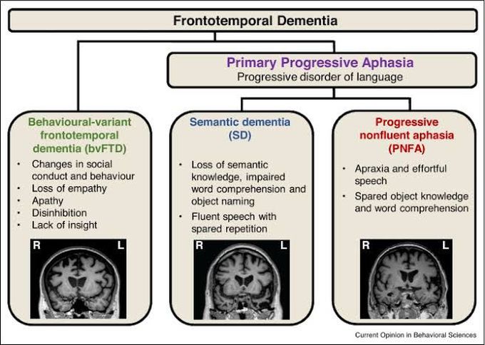 Frontotemporal dementia