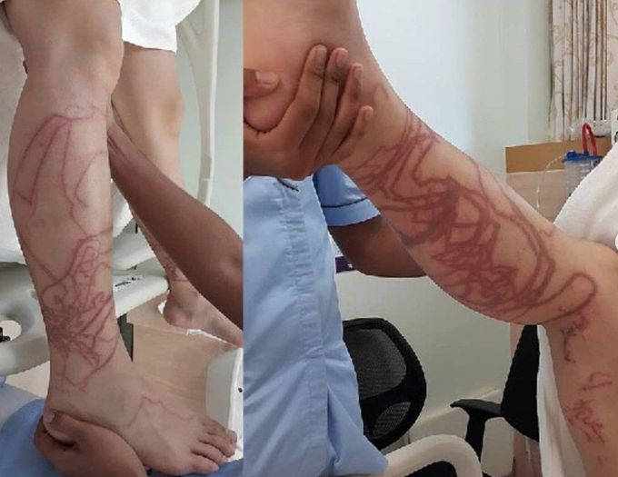 Stung by a jellyfish