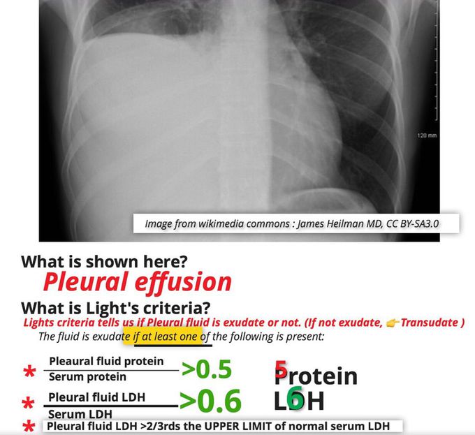 Pleural Effusion