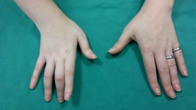 Reattachment of an Amputated Arm and Hand. Result 9 Years after Replantation.