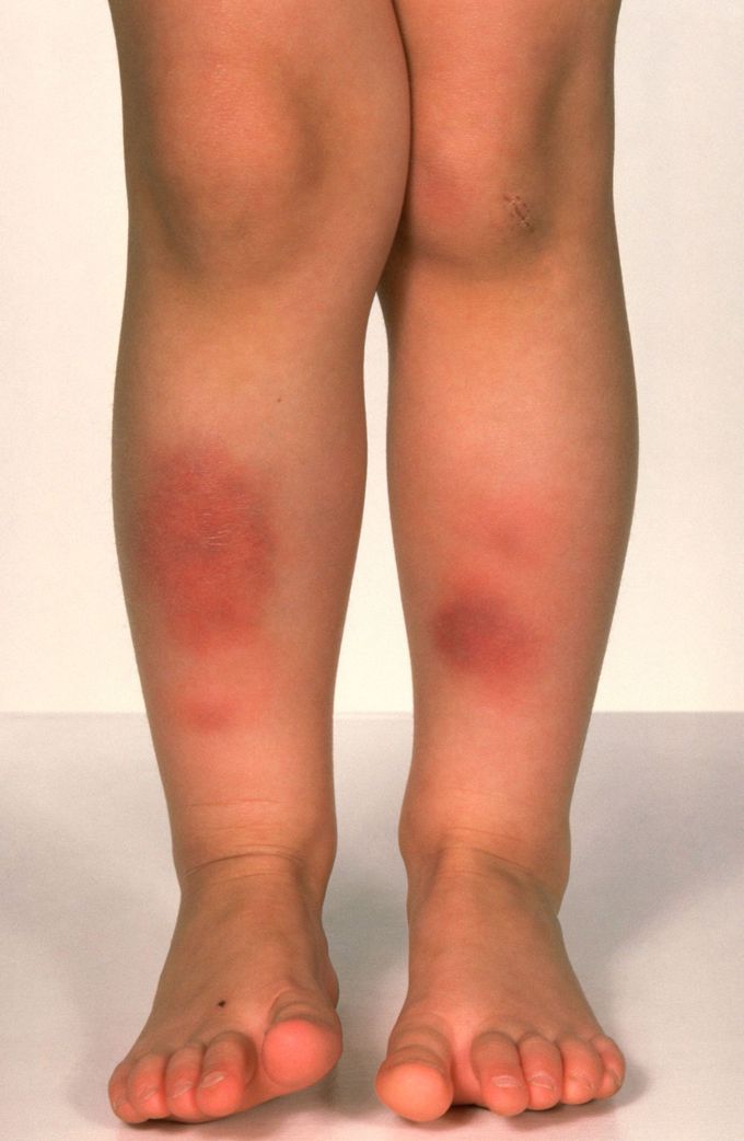 Symptoms of erythema nodosum