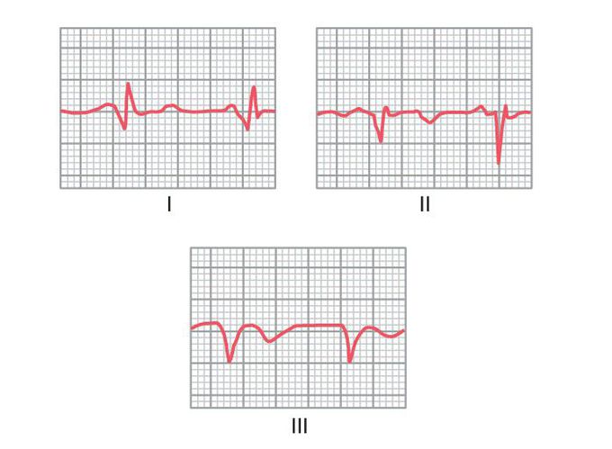 Myocardial infarction