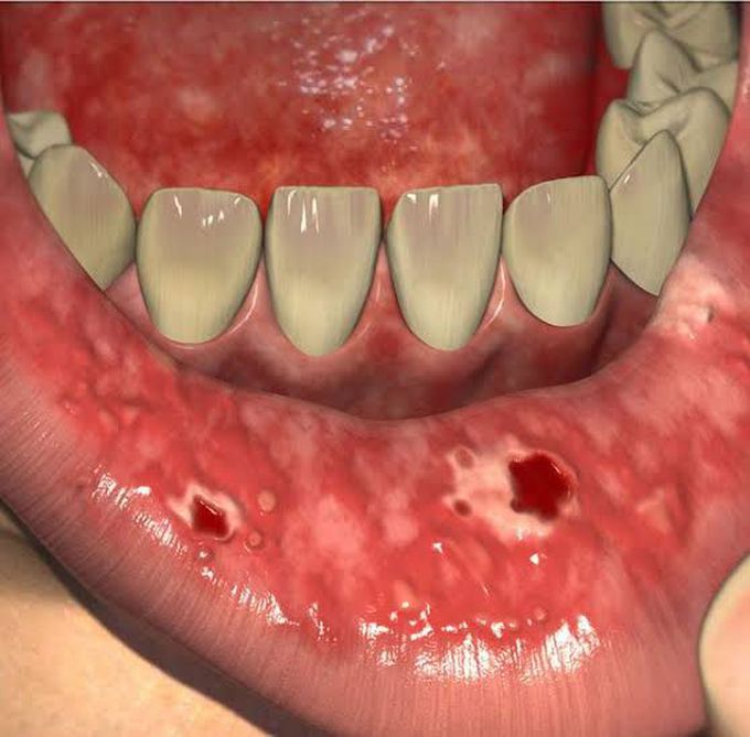 Management of mucositis