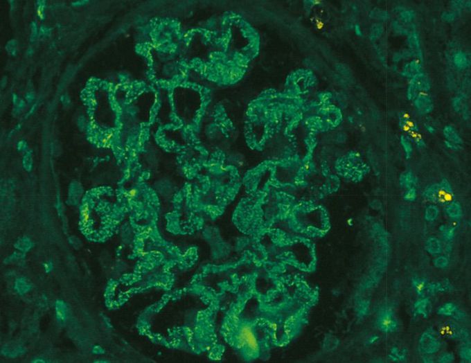 Renal disease