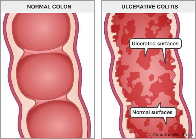 Causes of ulcerative colitis