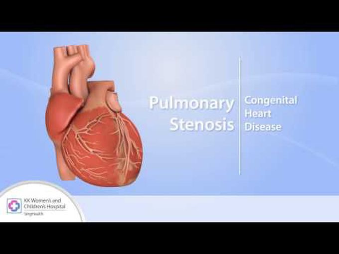 Congenital Pulmonary Stenosis