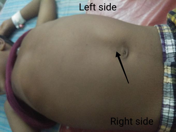 Sickle cell anaemia