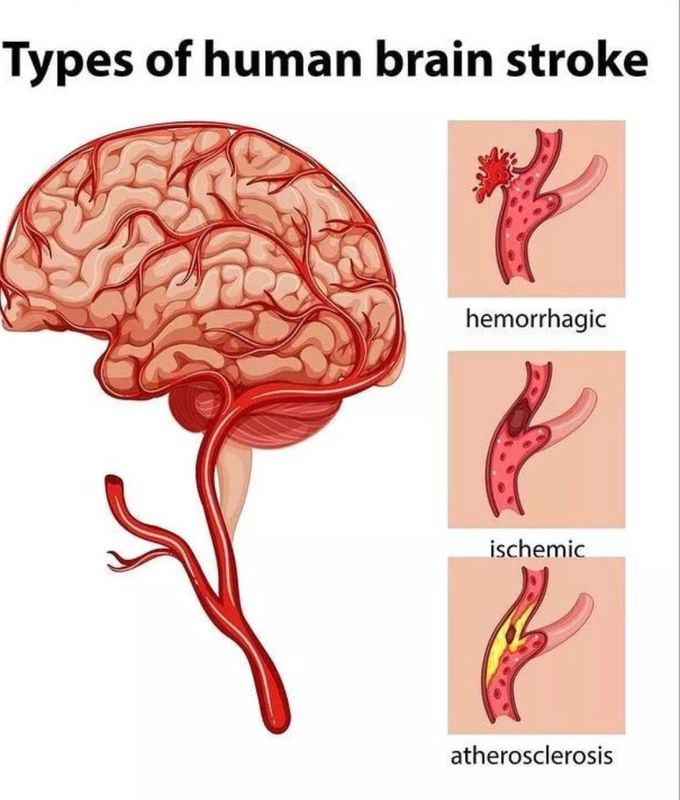 Types of Stroke