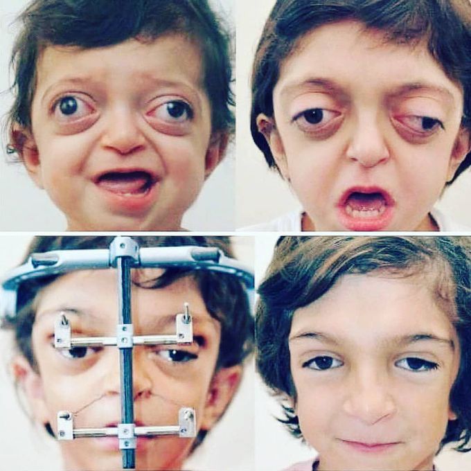 Crouzon syndrome