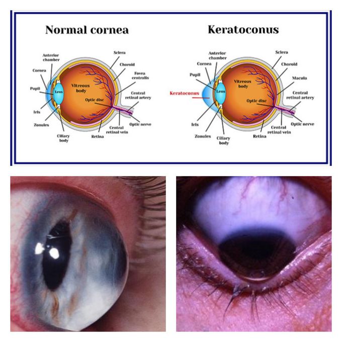 Keratoconus