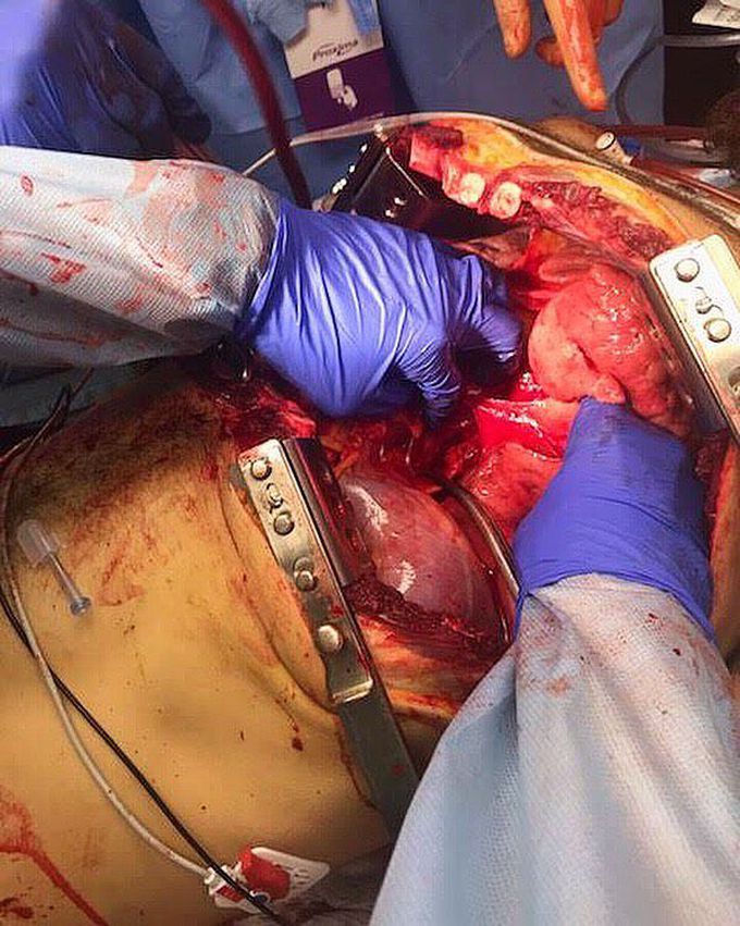Thoracotomy with direct cardiac massage in an attempt to resuscitate!! 