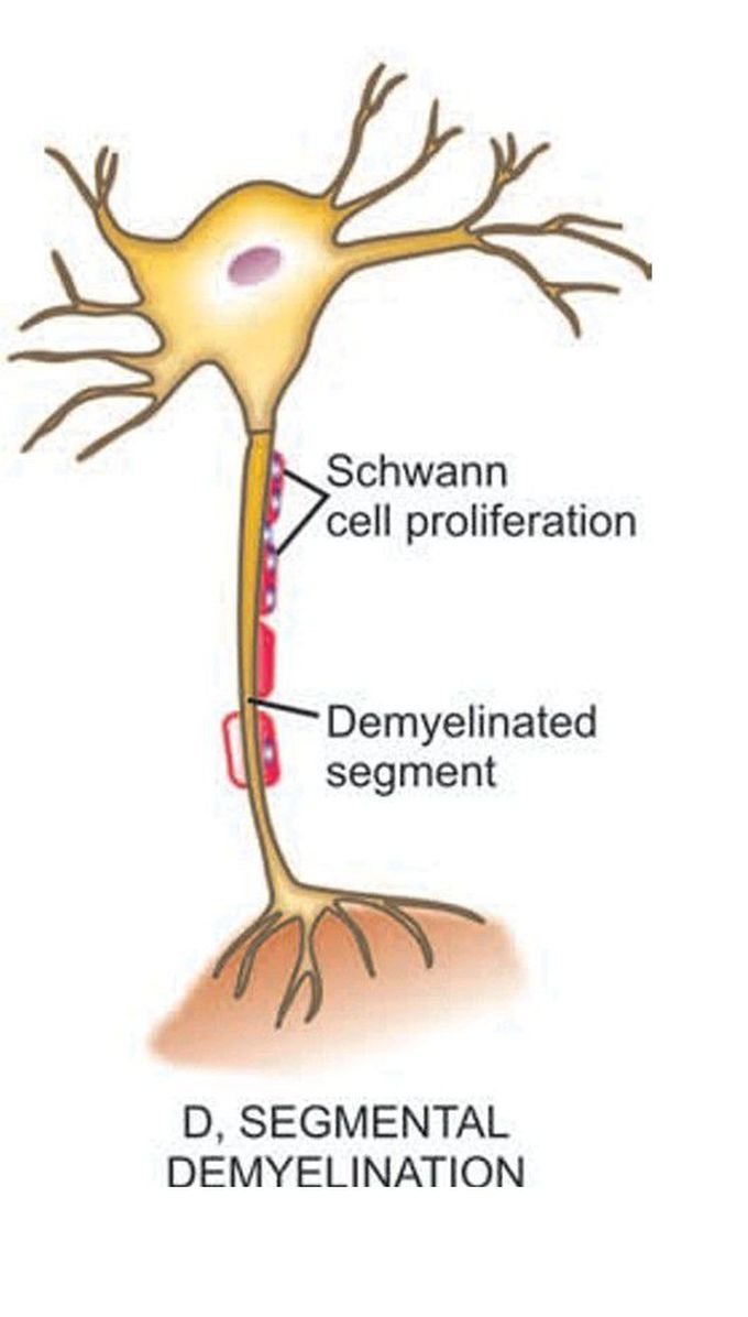 Pathologic reaction of peripheral nerve to injury (3)