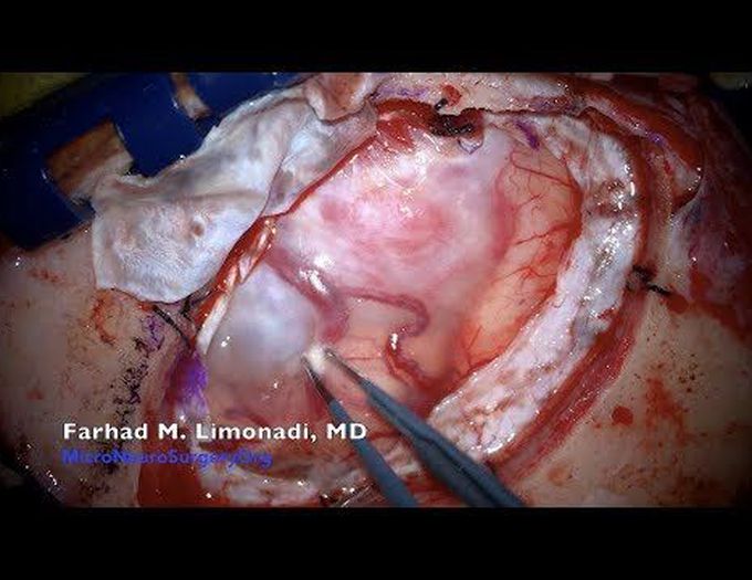 Brain tumor surgery: Removal of a frontal meningioma. View through the surgical microscope