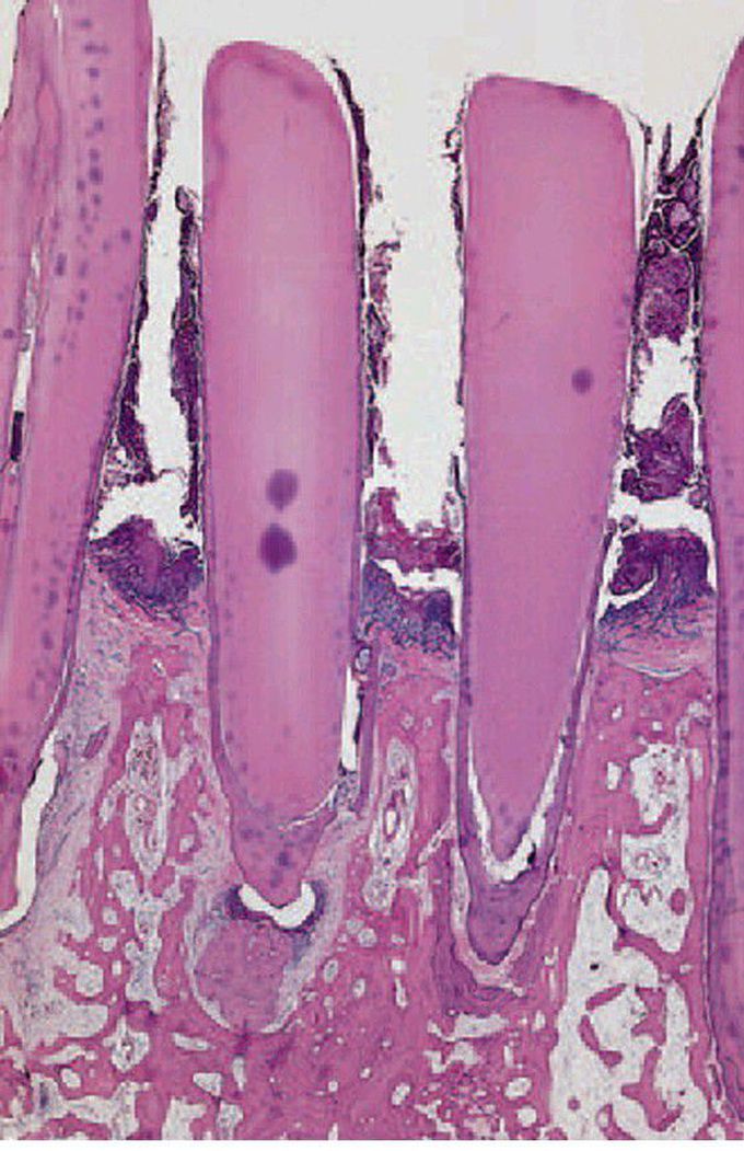 Periodontitis with recession.