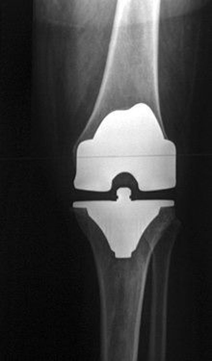 Total knee replacement