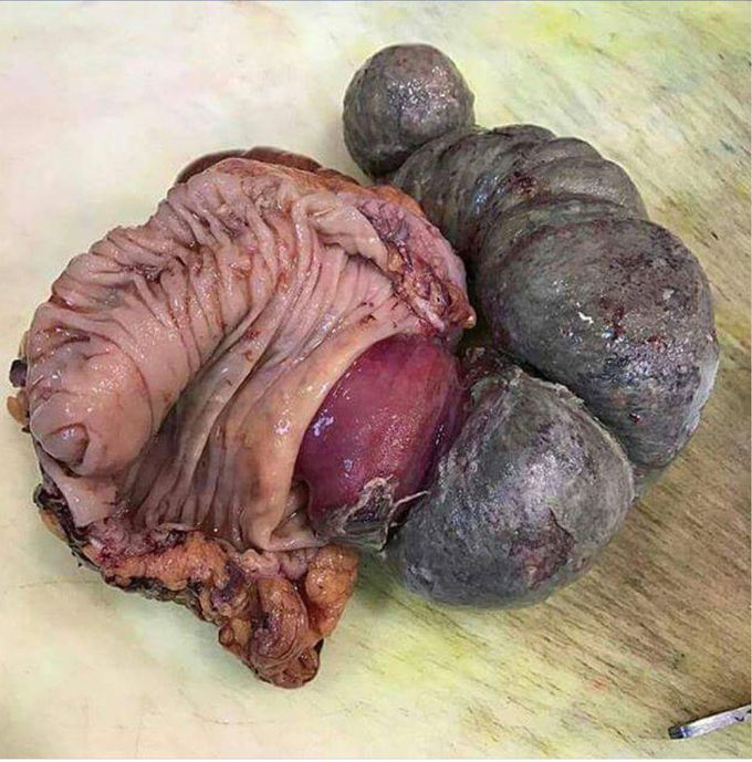 Intussusception.