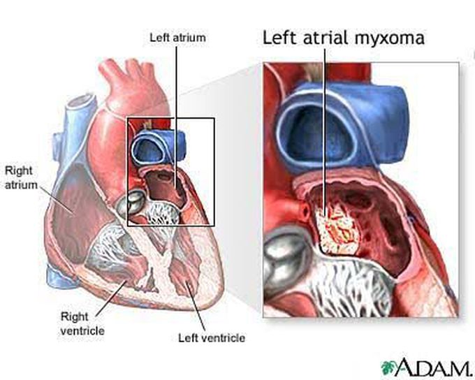 Diagnosis of myxoma