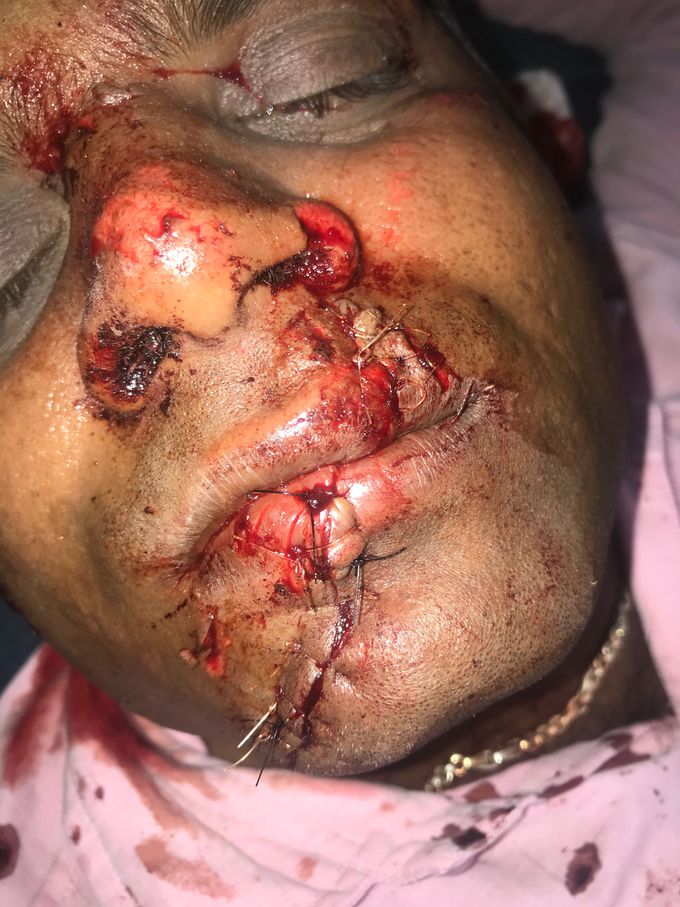 Facial trauma laceration lips and right face region