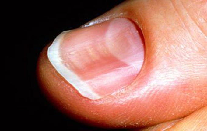 In which disease we see koilonychia??