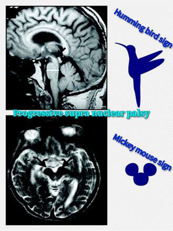 Psp- progressive supranuclear palsy is a Parkinson + disorder affecting subcortical areas