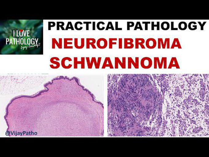 Peripheral Nerve Sheath Tumors
