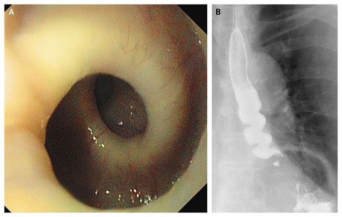 Nutcracker Esophagus