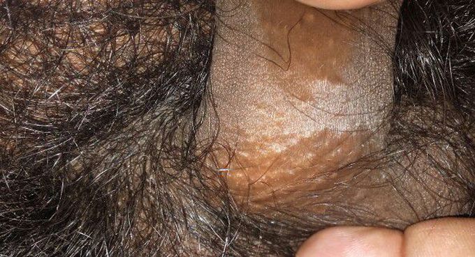 Itchy penis
