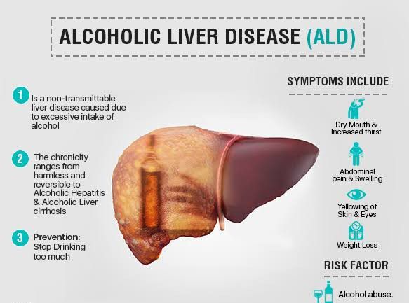 Alcohol Related Liver Disease Medizzy 