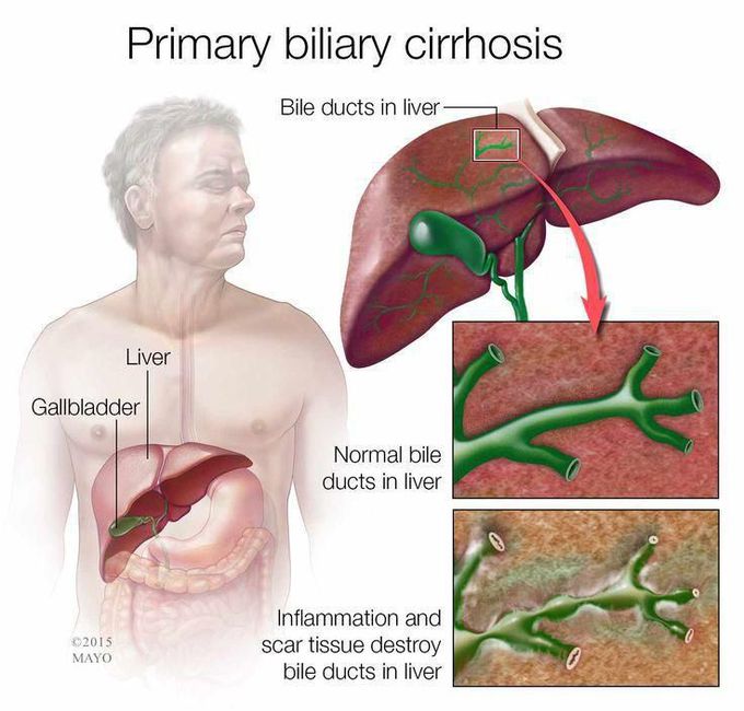 Primary Biliary Cholangitis