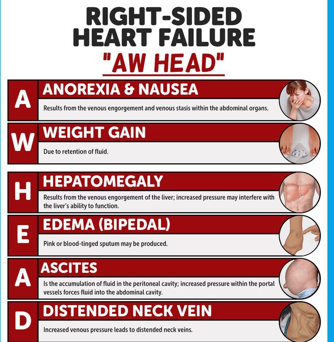 Right sided heart failure symptoms