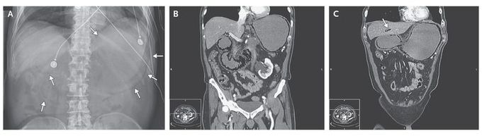Catastrophic Gastroduodenal Pneumatosis