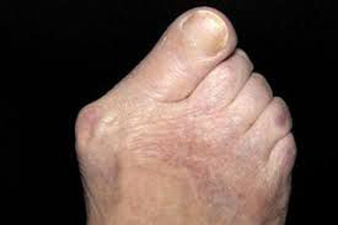 Types of bunions