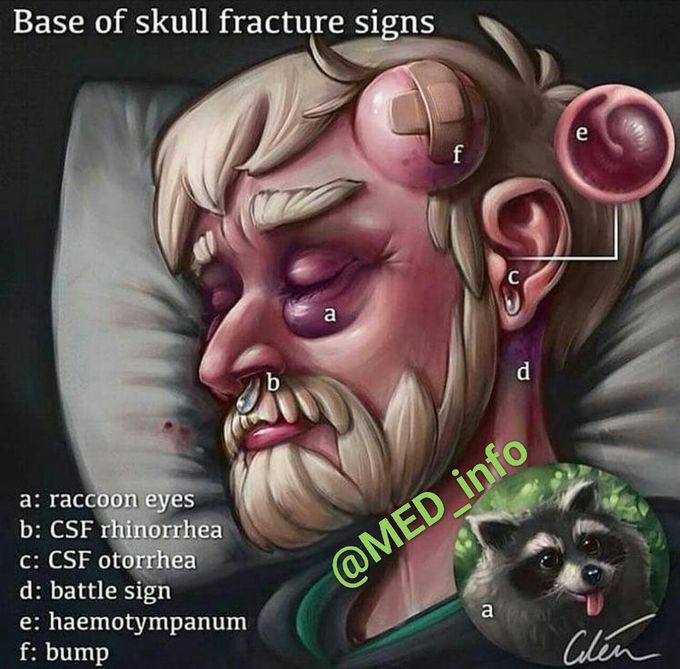 Base of skull fracture signs