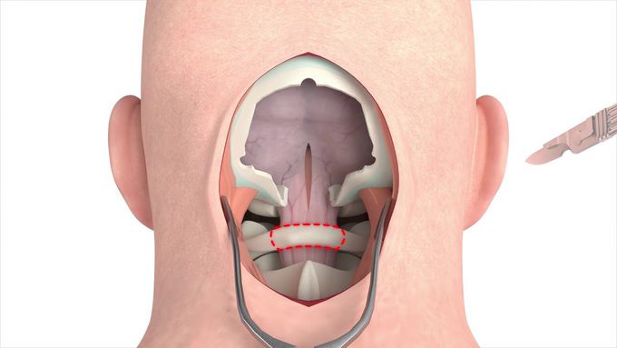 Procedural Craniectomy  (3D animation)
