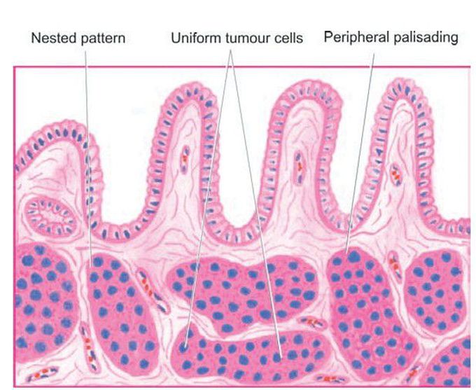 Tumor cells