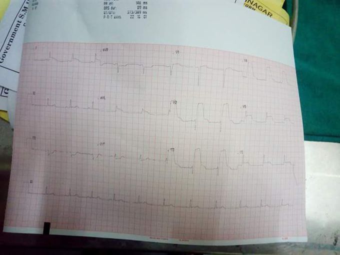 3 30 am this pt report  and claim slightly  chest pain dr advised ECG 
Diagnosis  👭