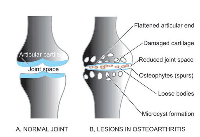 Osteoarthritis