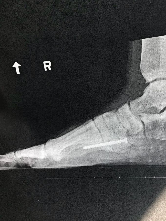 5th metatarsal repair surgery, 4 months post op