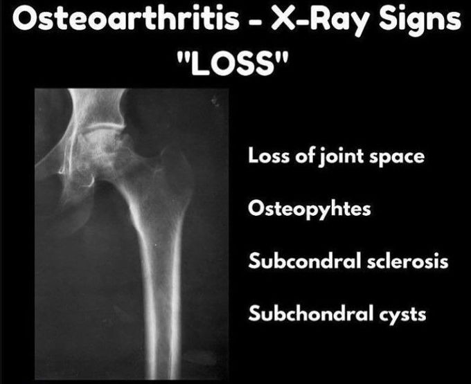 Osteoarthritis