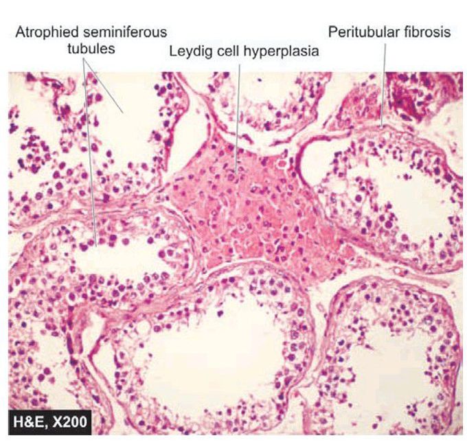 Testicular atrophy.