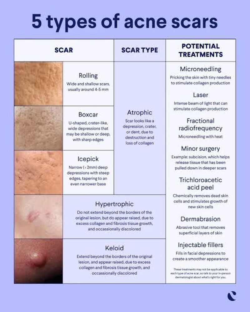 Types of acne scars discount